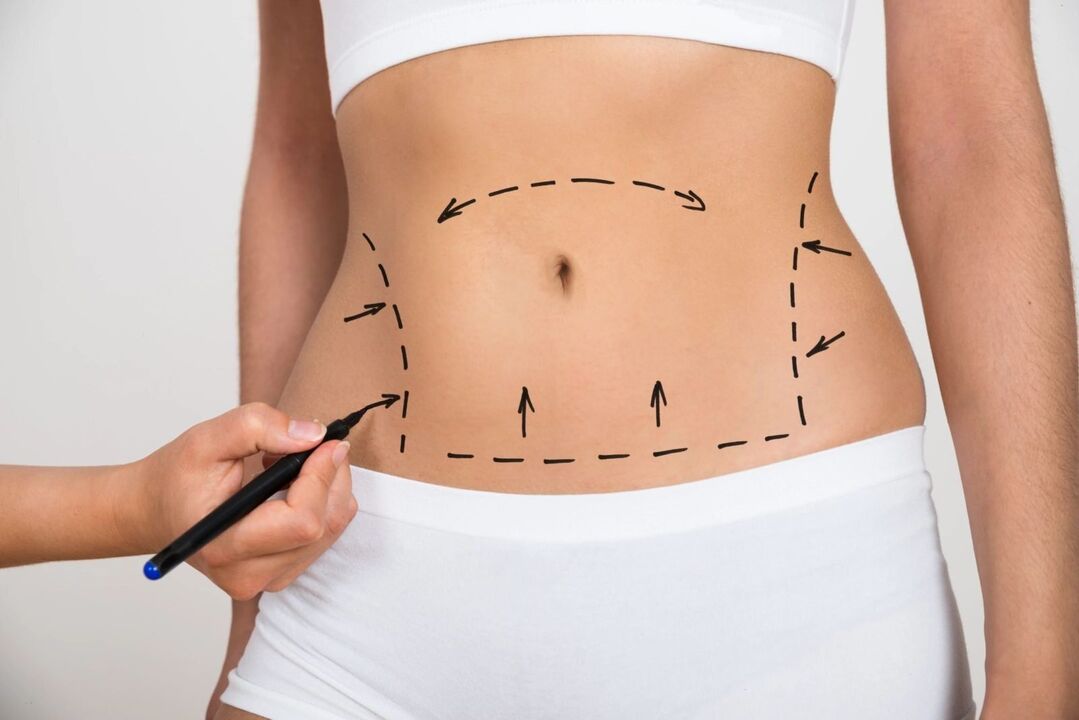 Abdominal marking before liposuction, shape correction
